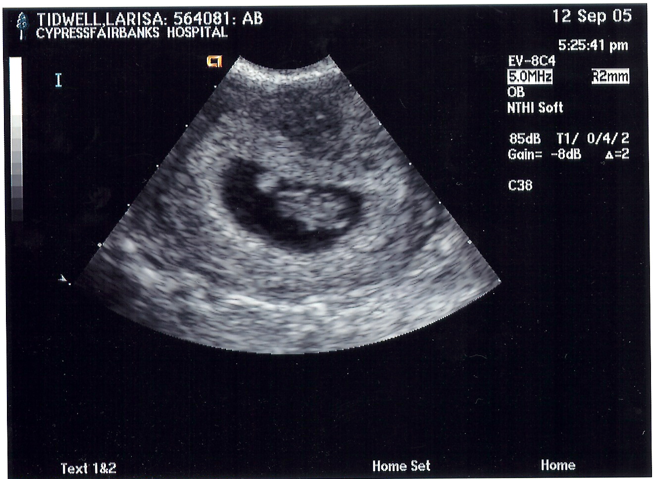 teddy bear sonogram